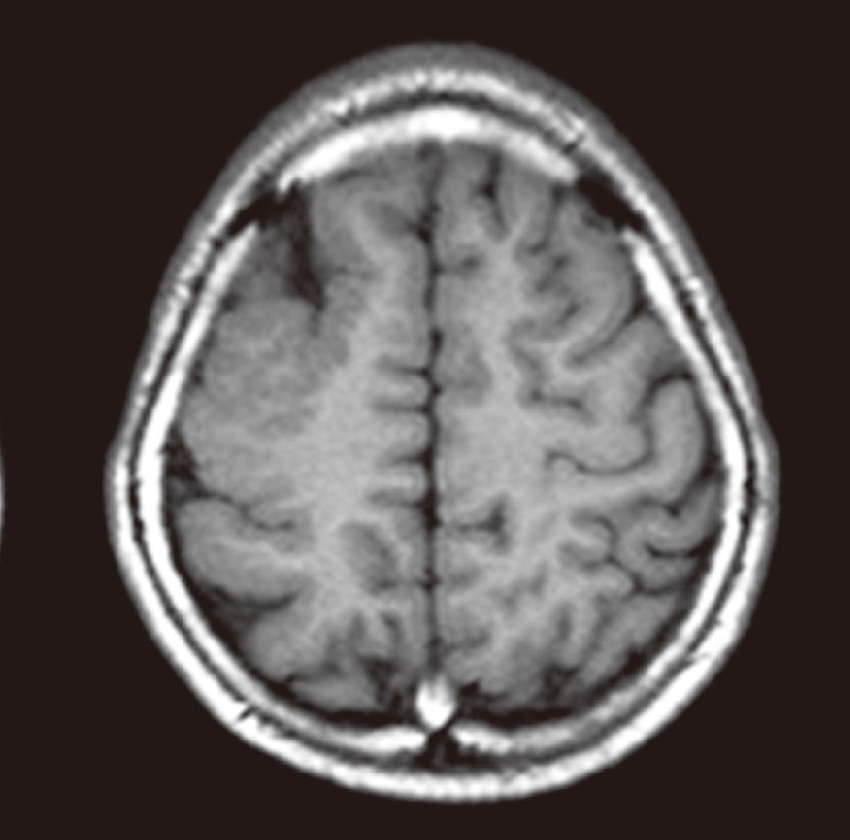 ⓔ図18-13-3　多小脳回 頭部MRI T1強調画像，水平断．右前頭部に異常に浅い脳溝を伴った皮質を認める．