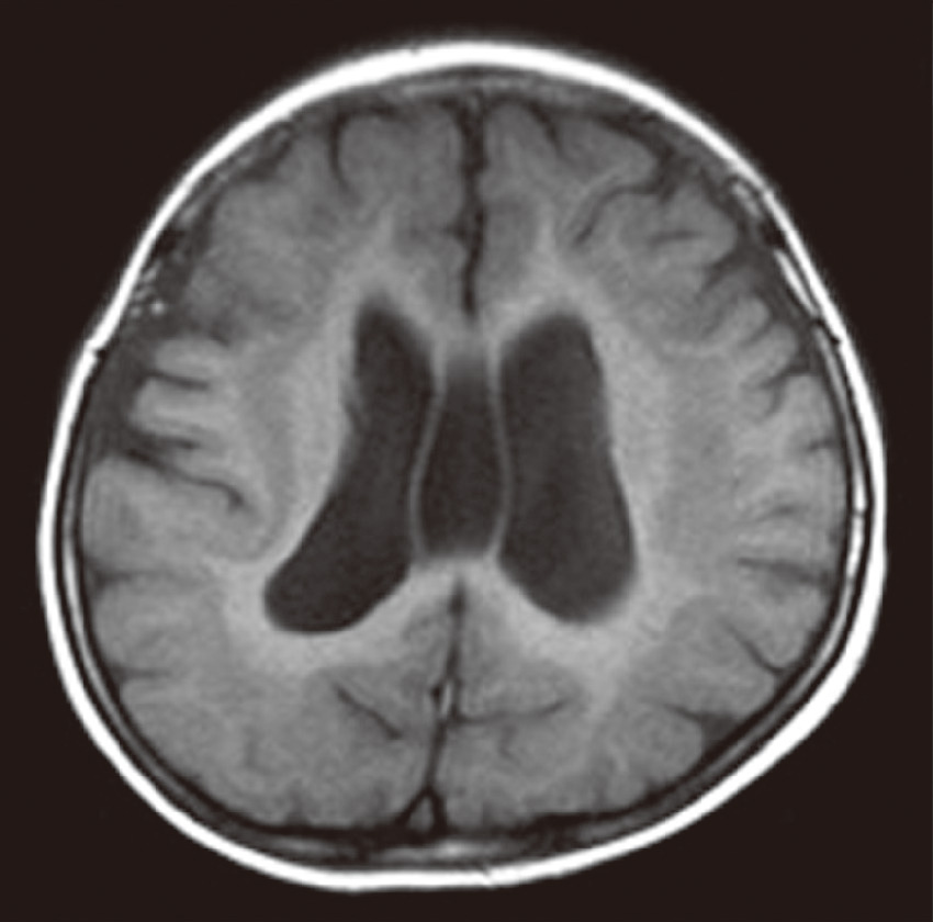 ⓔ図18-13-4　皮質下帯状異所性灰白質 頭部MRI T1強調画像，水平断．両側前頭部から頭頂部に，皮質の内側にもう1層の灰白質を帯状に認める．