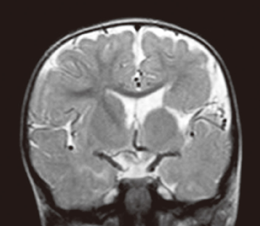 ⓔ図18-13-5　裂脳症 頭部MRI T2強調画像，冠状断．左側脳室から脳表に連続する脳組織の欠損を認める．