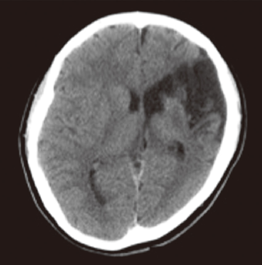 ⓔ図18-13-6　孔脳症 頭部CT．左前側頭部に脳組織の脱落を認める．