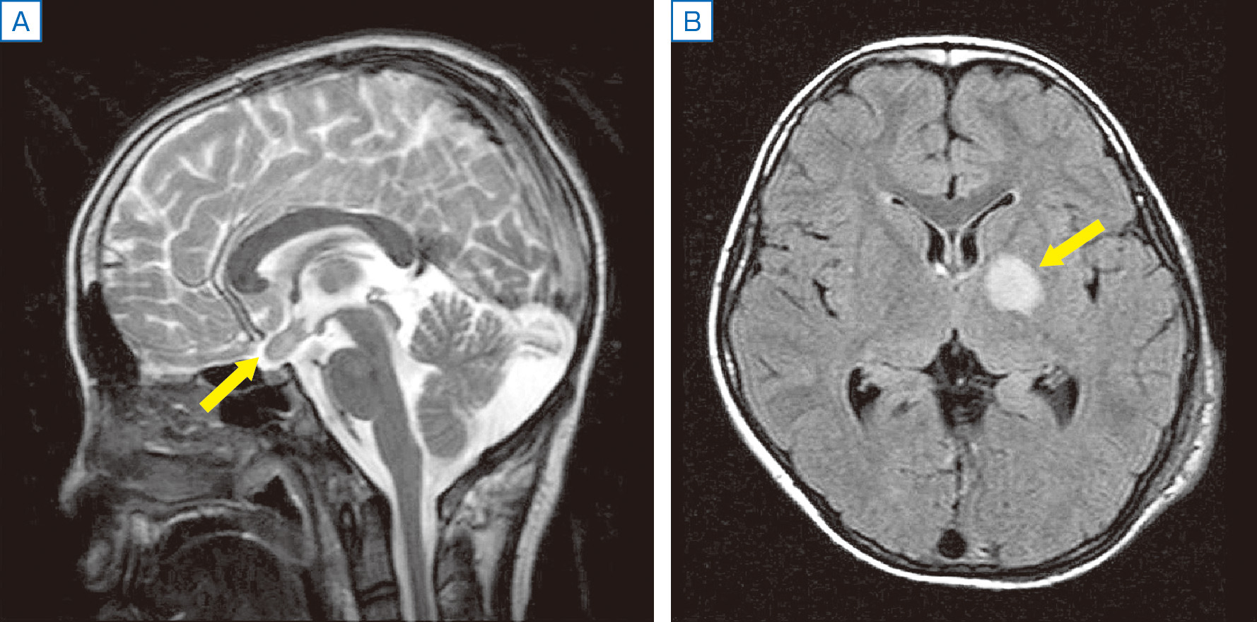 ⓔ図18-13-7　神経線維腫症1型 A：視神経膠腫，頭部MRI，T2強調画像，矢状断． B：unidentified bright object，頭部MRI，FLAIR画像，水平断．