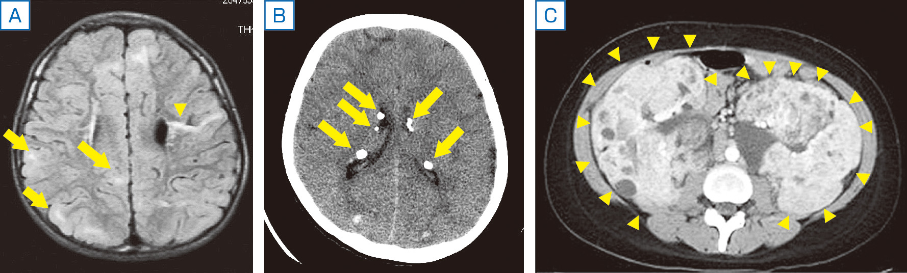 ⓔ図18-13-8　結節性硬化症 A：皮質結節 (矢印) とradial migration line (矢頭)，B：上衣下結節 (石灰化を伴う)，頭部MRI，FLAIR画像，水平断，C：腎血管脂肪腫 (両側性)，頭部MRI，T2強調画像，水平断．
