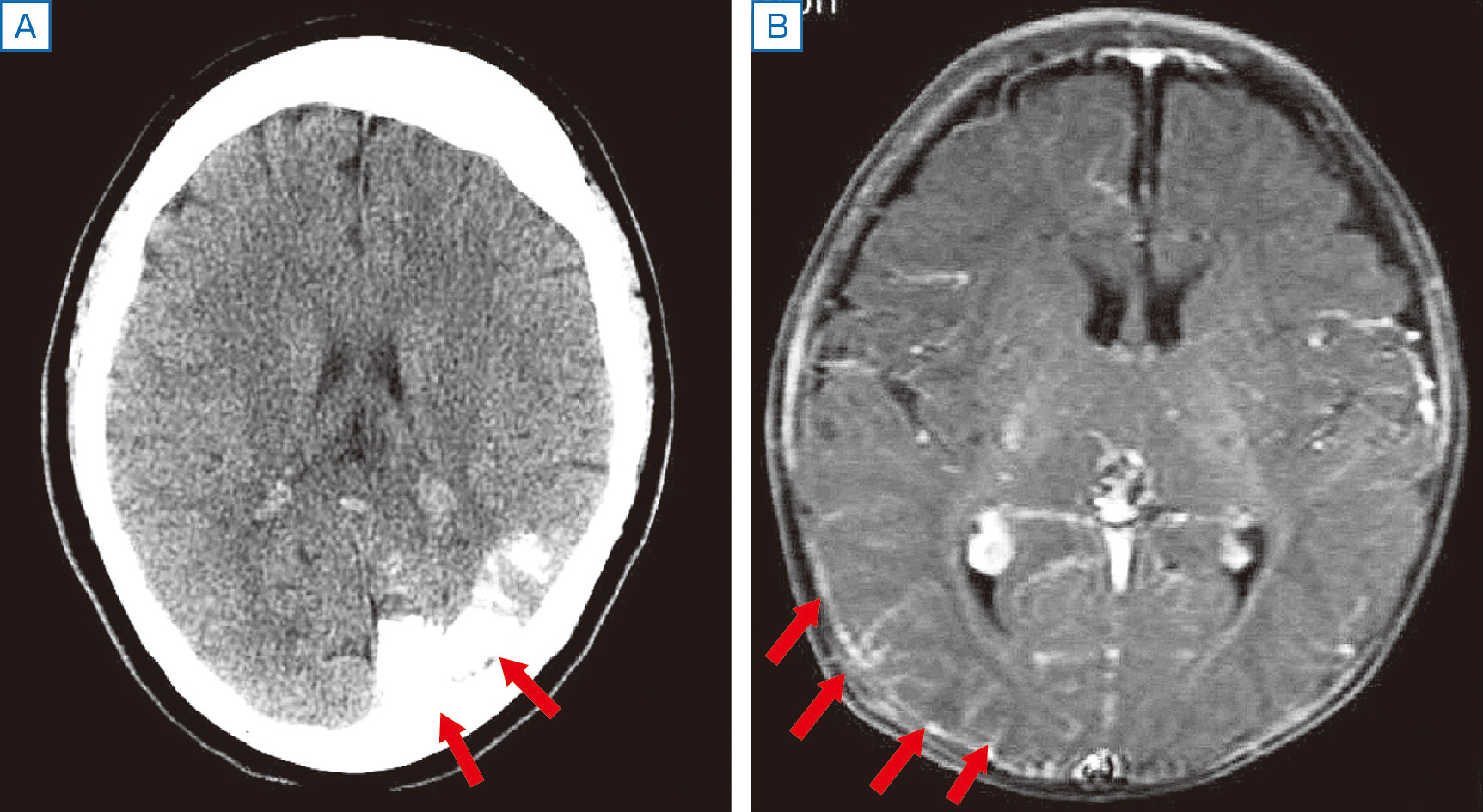 ⓔ図18-13-9　Sturge–Weber症候群 A：頭部CT，病変部の石灰化像． B：頭部MRI，造形T1強調画像，水平断．造影される脳軟膜の血管腫．