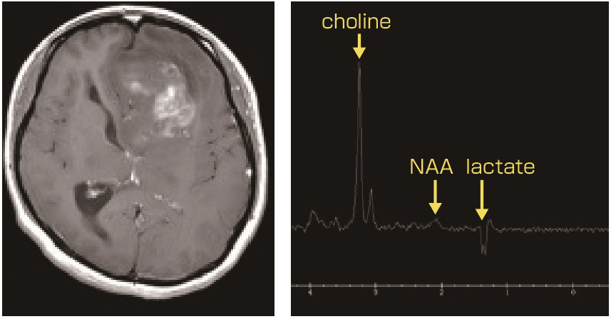 ⓔ図18-14-1　左前頭葉膠芽腫 造影T1強調MRI (左)，腫瘍部分のMRS (右)．MRSでcholineの上昇をみる．