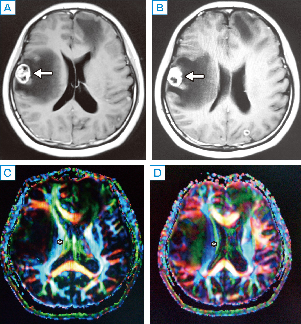 ⓔ図18-14-2　右前頭葉転移性脳腫瘍 造影T1強調MRI (上)，tractography (下)．tractographyでは，腫瘍周辺の脳浮腫により右側錐体路 (＊) が圧迫を受けていることがわかる．
