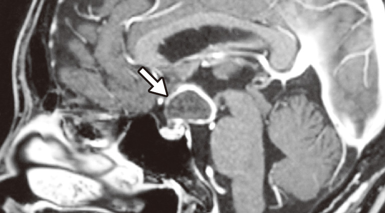 ⓔ図18-14-3　頭蓋咽頭腫の画像診断 (MRI) 