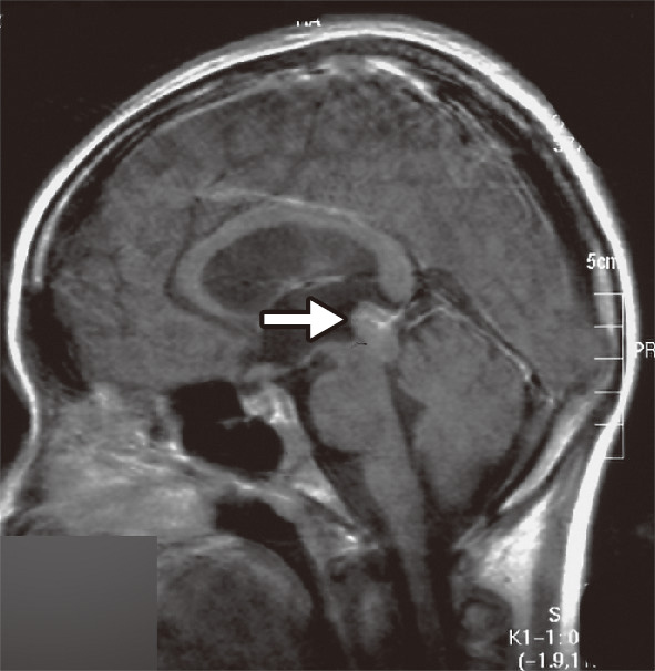 ⓔ図18-14-4　胚細胞腫 (松果体部) の画像診断 (MRI) 