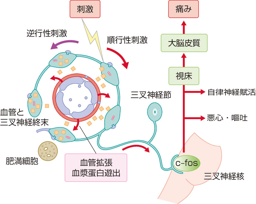 ⓔ図18-17-1　三叉神経血管説のシェーマ (竹島多賀夫，菊井祥二：小児科診療，2013; 8: 1311–1318) まず最初に何らかの頭痛トリガーが硬膜血管周囲に分布する三叉神経終末を刺激して三叉神経が興奮，活性化される．この結果CGRPやサブスタンスＰなどの血管作動性神経ペプチドが放出され血管拡張，血漿の血管外漏出，引き続いて肥満細胞の脱顆粒が起こる．すなわち神経原性炎症が引き起こされる．神経原性炎症による三叉神経刺激により炎症が順行性および逆行性に三叉神経領域に拡大する．拡大した神経原性炎症は侵害刺激として作用し，侵害信号が順行性に脳幹，三叉神経核を経て大脳皮質へと伝達され，頭痛として感受される．