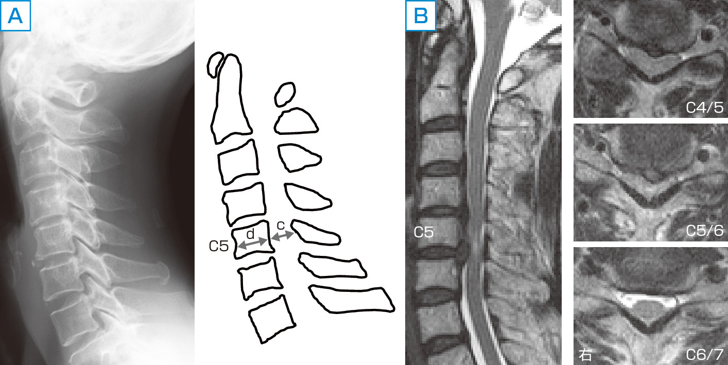 ⓔ図18-18-1　脊柱管狭窄を伴う頸椎症 A：単純X線側面像．椎間板腔の狭小化はC4/5に軽度に認めるのみで，骨棘もない．脊柱管前後径は11.0 mm (c)．C5椎体の前後径と脊柱管前後径 (Torg–Pavlov比；c/d) は11.0/16.0＝68.7％である．図18-18-5と比較すると脊柱管の前後径が狭いことがわかる． B：MRI T2強調像．脊髄がC4/5，C5/6椎間で圧迫されており，髄内高信号を認める．発達性脊柱管狭窄があると頸椎症性変化は軽度でも脊髄圧迫を起こしやすい．