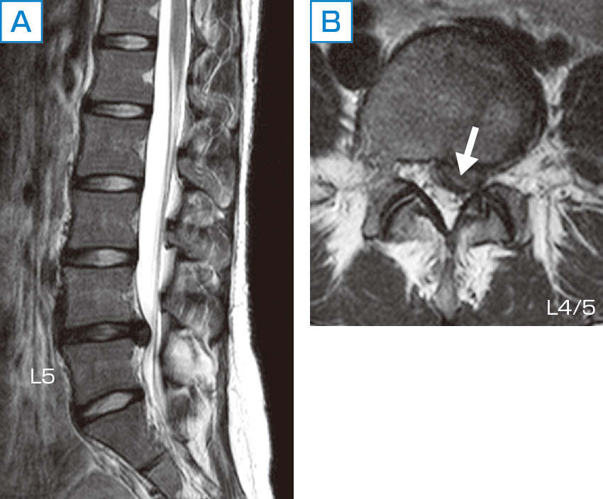 ⓔ図18-18-2　腰椎椎間板ヘルニアのMRI画像 (T2強調画像) 左後外側型椎間板ヘルニア (矢印) を認める．