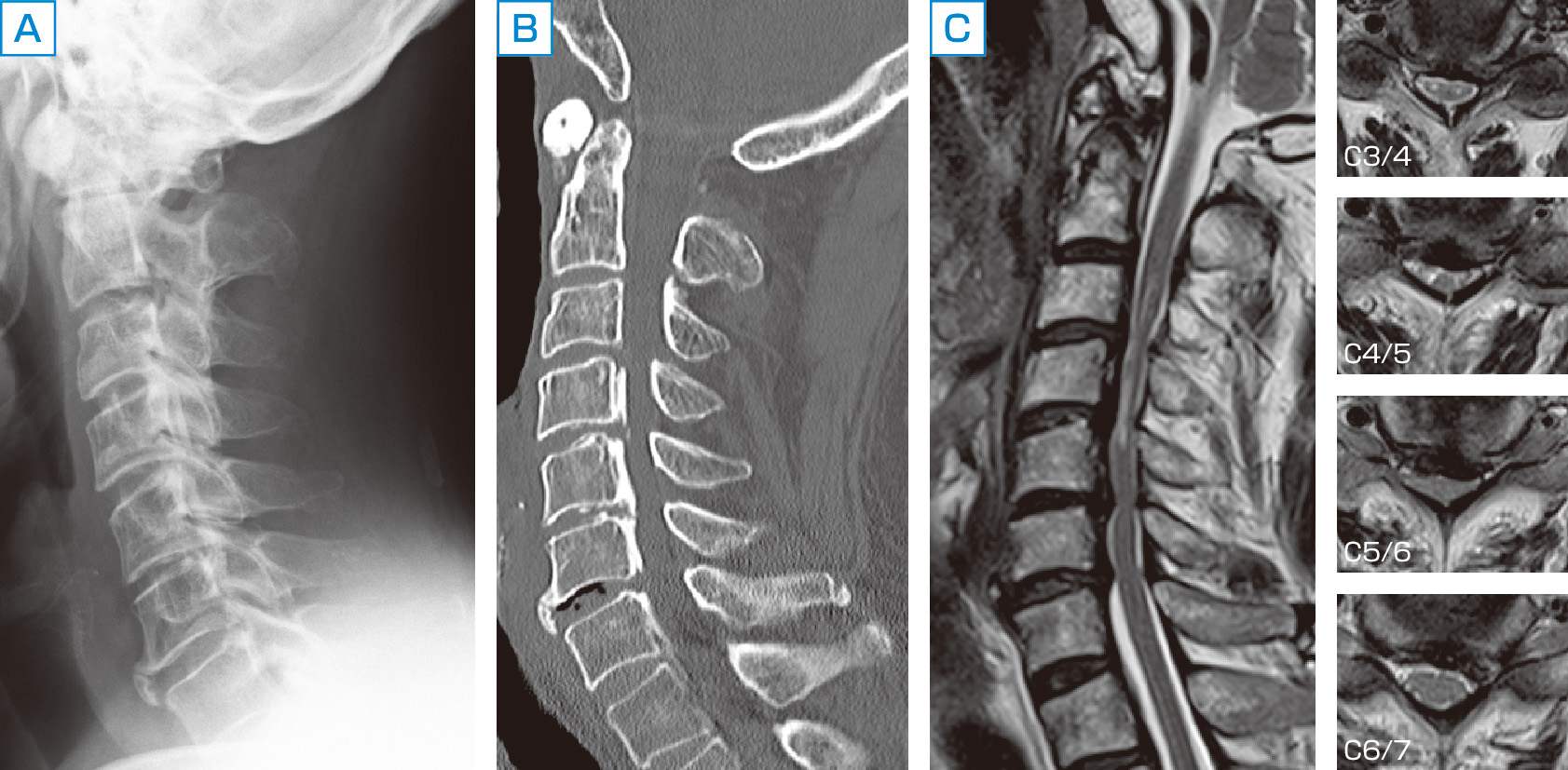 ⓔ図18-18-3　頸椎後縦靱帯骨化症 (分節型) A：単純X線側面像．B：CT再構成画像矢状断．C：MRI T2強調像 (矢状断，横断)． 頸椎後縦靱帯骨化症 (OPLL) をC4からC7椎体レベルに分節性に認める．OPLLは椎体後方でX線，CTでは高吸収，MRIでは低信号として認める．脊髄はC3/4椎間からC5/6椎間まで圧迫されており，C3/4，C4/5椎間では髄内高信号を両側の脊髄中心部に認める．