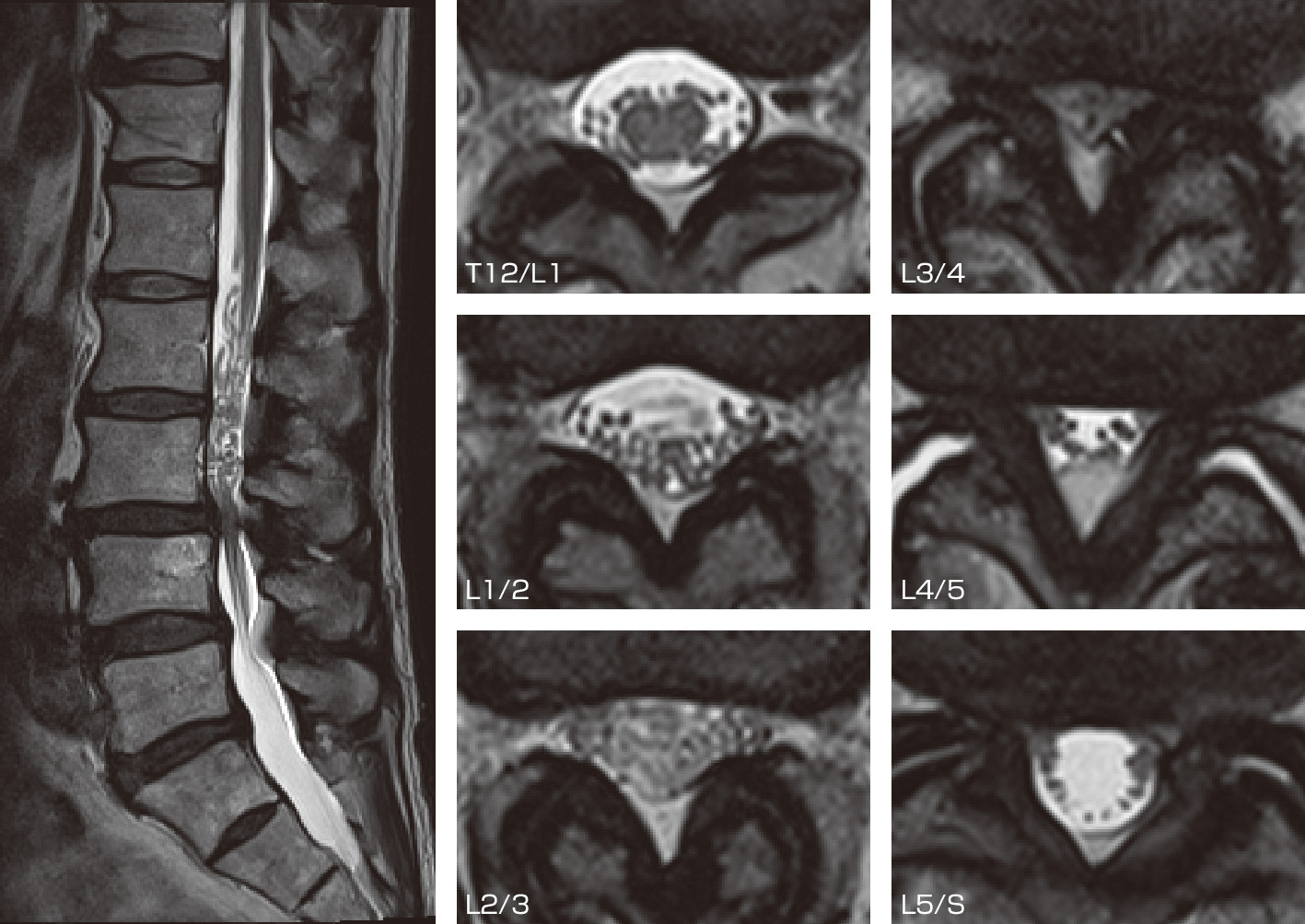 ⓔ図18-18-4　余剰神経根 (redundant nerve roots) を認める脊柱管狭窄症 本症例ではL3/4椎間で馬尾が絞扼されており，それよりも上部の馬尾があたかも蛇がとぐろを巻いているように蛇行してみえる．血管奇形や脊髄硬膜動静脈瘻と誤診されることがあるので，注意が必要な所見である．