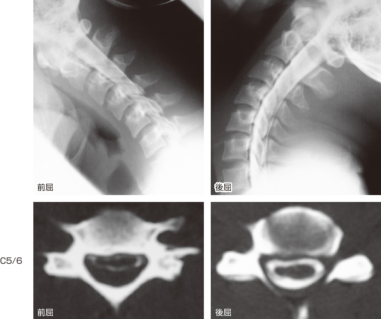 ⓔ図18-18-5　若年性一側上肢筋萎縮症のmyelography，CT myelographyの前屈と後屈の比較 myelography後屈では硬膜管に異常は認めないが，前屈位では下位頸椎レベルで硬膜管の後壁が前方に移動している．C5/6椎間のCT myelographyでは後屈位では，脊髄は右優位に扁平化しているが，硬膜管には余裕がある．前屈位では，硬膜管後壁が前方に移動して脊髄を圧迫している．