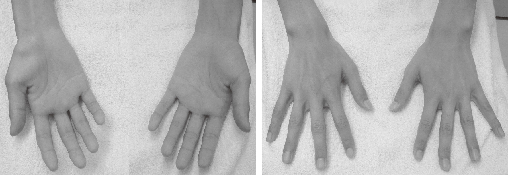 ⓔ図18-19-2　真の神経性TOS患者の手 (園生雅弘：整形・災害外科，2019; 62: 119–128より許可を得て引用) 右 (患側) で母指球の著明な萎縮 (上) と，小指球筋・背側骨間筋の軽度萎縮 (下) を認める．