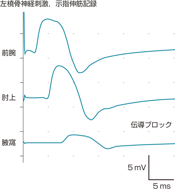 ⓔ図18-19-4　橈骨神経麻痺症例での運動神経伝導検査 腋窩～肘上間で伝導ブロックを認め，橈骨神経麻痺と診断される．遠位の複合筋活動電位振幅はよく保たれており予後は良好と推測される．