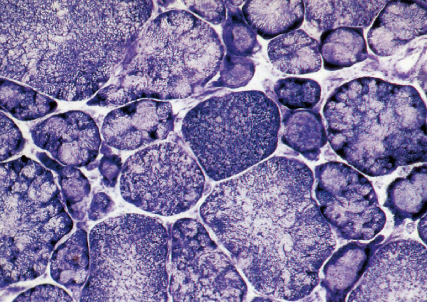ⓔ図18-21-5　分葉線維 (NADH–TR染色) 肢帯型筋ジストロフィーではしばしばタイプ1線維が細く，クローバ様の分葉を呈する．これはカルパイノパチー (LGMD2A) で最も顕著にみられる．