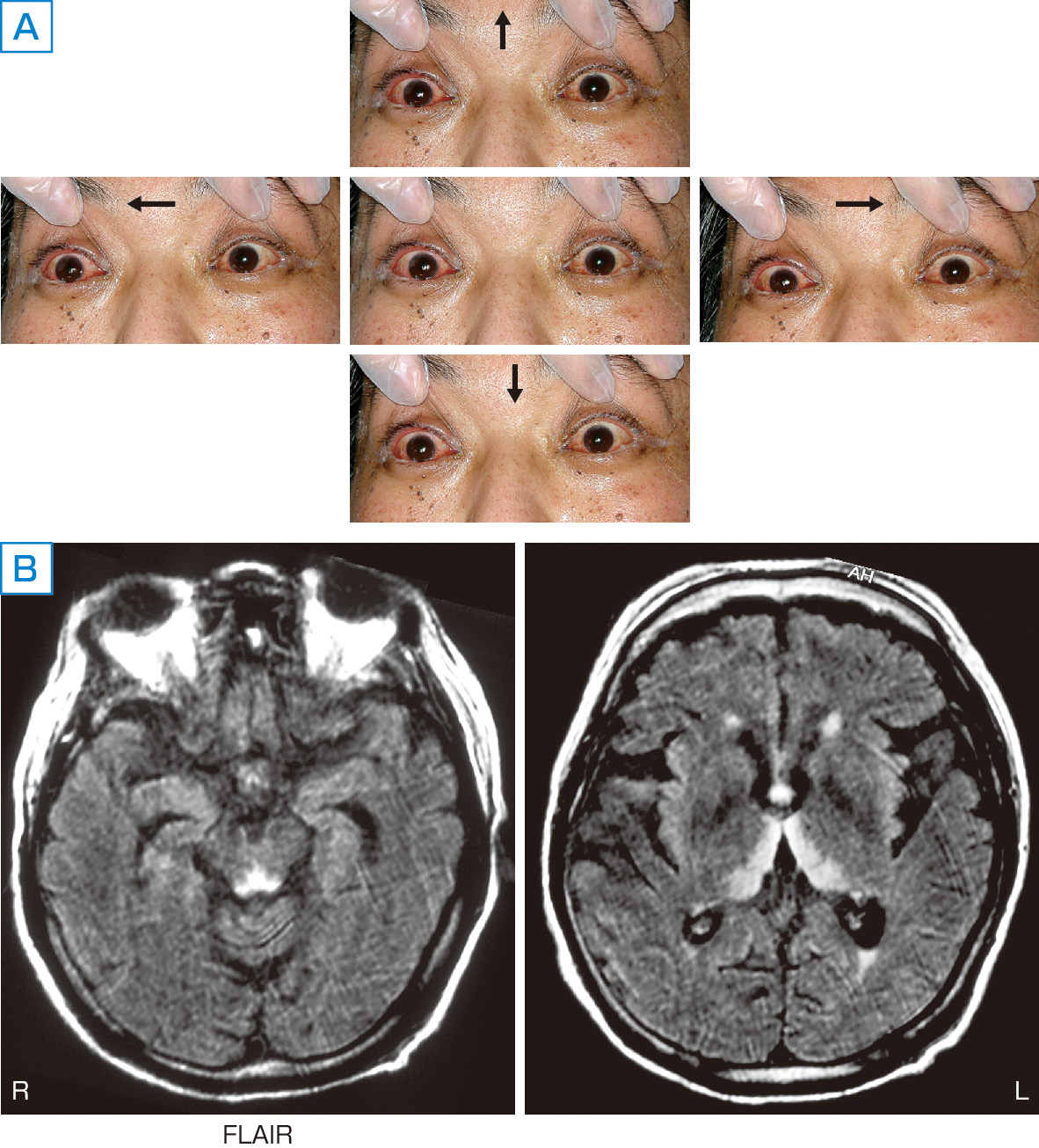 ⓔ図18-3-10　Wernicke脳症 下顎脱臼のため食事摂取が不十分となり，その後めまい感のため自宅で動けなくなり来院した55歳男性．血中チアミン濃度は5 ng/mL未満であった．眼球運動は全方向で制限され (A)，MRIで特徴的な病変の広がり (中脳水道周囲，視床下部，乳頭体，視床内側部) が確認された (B)．チアミン補充により症状，MRI所見とも完全に消失した．