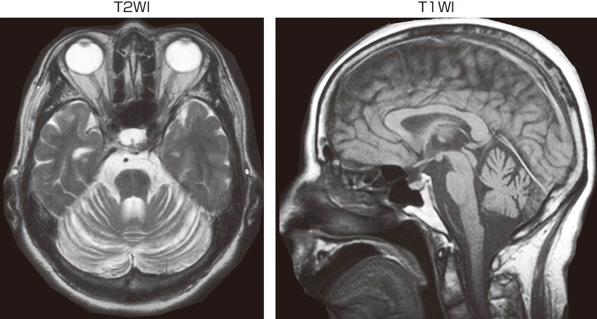 ⓔ図18-3-11　脊髄小脳変性症 63歳の女性．オリーブ橋小脳萎縮症 (多系統萎縮症小脳型：MSA–C) により，数年の経過でふらつき，歩行障害，構音障害が徐々に進行した．MRIでは小脳と脳幹の萎縮が目立つ．よく見るとT2強調画像で橋に特徴的な横走線維の変性 (十字サイン) も認める．診察上は小脳性運動失調が明らかであった．