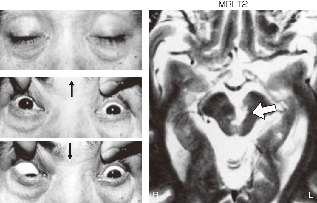ⓔ図18-3-2　中脳病変による両側眼瞼下垂と垂直性眼球運動障害 めまいとともにものが見えにくくなった57歳男性．両側眼瞼下垂，上方注視麻痺，左眼の下転障害を認めた．MRI (T2強調画像) で，中脳に梗塞巣が確認できる．