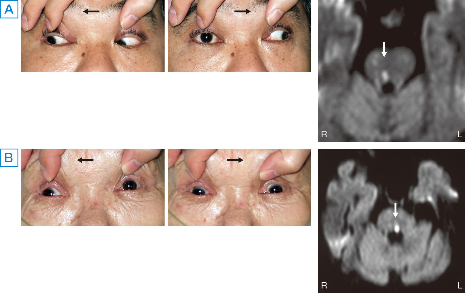 ⓔ図18-3-3　橋被蓋部病変による水平性眼球運動障害 A：めまいと複視で来院した41歳男性．右眼の内転障害 (MLF症候群) を認めた．MRI (拡散橋病画像) を施行したところ，右傍正中橋被蓋部の梗塞が確認できた． B：めまいと複視で来院した75歳女性．左眼の内転障害と左方注視麻痺 (one–and–a–half症候群) を認めた．MRI (拡散強調画像) を施行したところ，左傍正中橋被蓋部に梗塞を認めた．