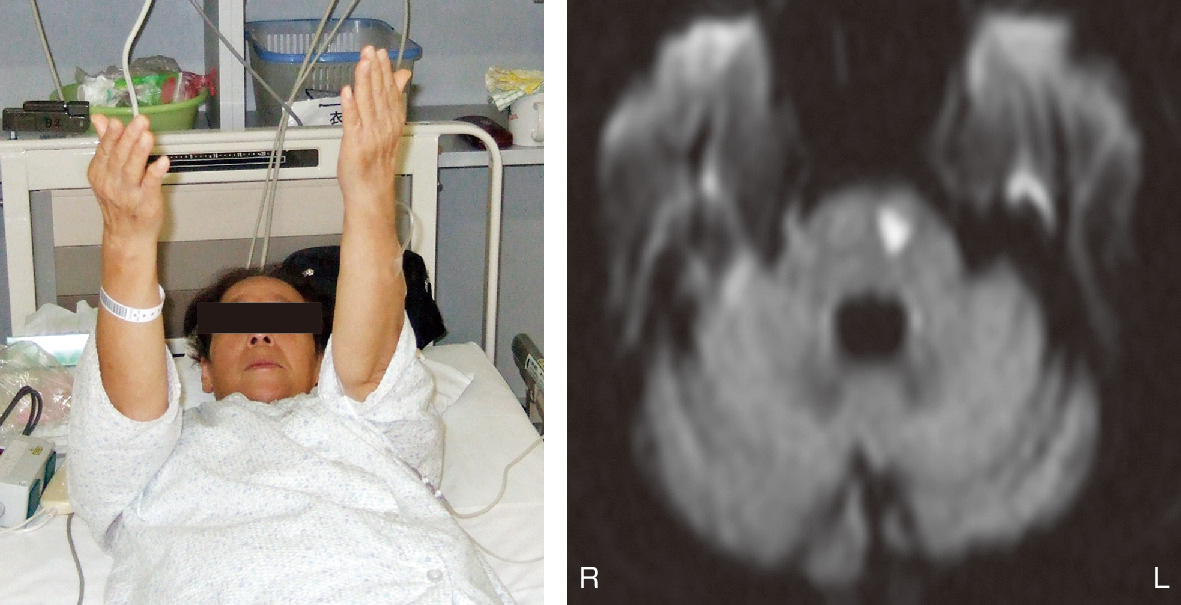 ⓔ図18-3-4　橋底部病変による不全片麻痺 めまいと右手の使いづらさで搬送されてきた75歳女性．右手が軽度回内し，下垂することから不全片麻痺が確認できる (Barré徴候陽性)．MRI (拡散強調画像) で右橋底部に梗塞を認めた．
