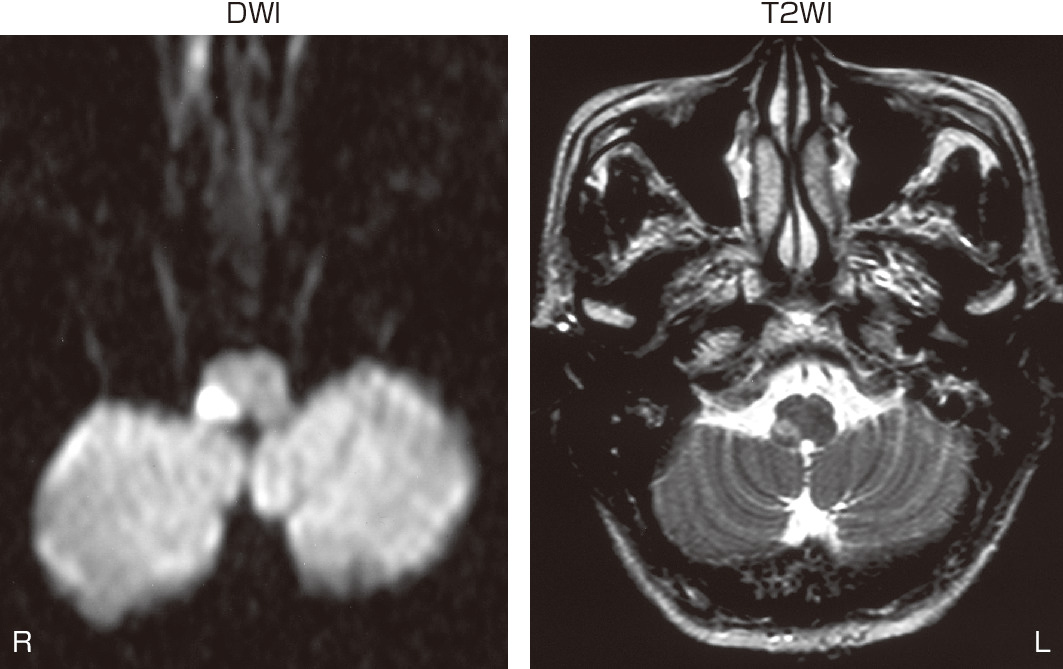 ⓔ図18-3-5　延髄外側病変によるWallenberg症候群 めまいのほかに，構音障害，嚥下障害，左半身感覚低下 (しびれ感) のある72歳男性 (Wallenberg症候群)．MRI拡散強調画像 (左) で右延髄に梗塞を認めた．同部はT2強調画像でもすでに高信号となっていた (右)．