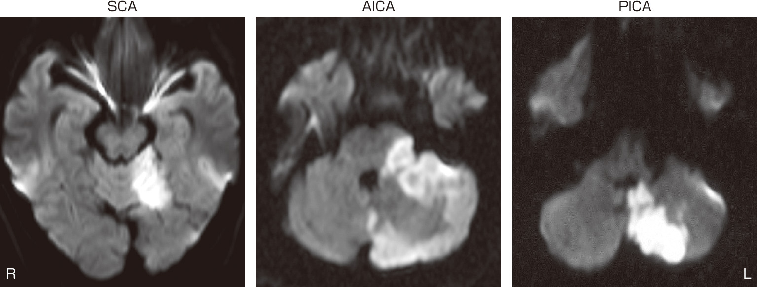 ⓔ図18-3-6　小脳の各動脈領域の梗塞 上小脳動脈 (SCA)，前下小脳動脈 (AICA)，後下小脳動脈 (PICA) 領域の梗塞のMRI拡散強調画像．SCA領域の梗塞では，患側の上下肢の肢節運動失調と構音障害をきたす．AICA領域の梗塞も，患側の上下肢の肢節運動失調をきたす．AICAは同側の橋外側や内耳も灌流しているため，図に示すように橋の外側にも梗塞が及び，患側の顔面麻痺や難聴を伴うこともある．PICA領域の梗塞では顕著な体幹失調をきたすが，肢節運動失調や構音障害は目立たない．なお，ここでは示していないが，PICA領域の梗塞では延髄外側に梗塞が及ぶことも多い．
