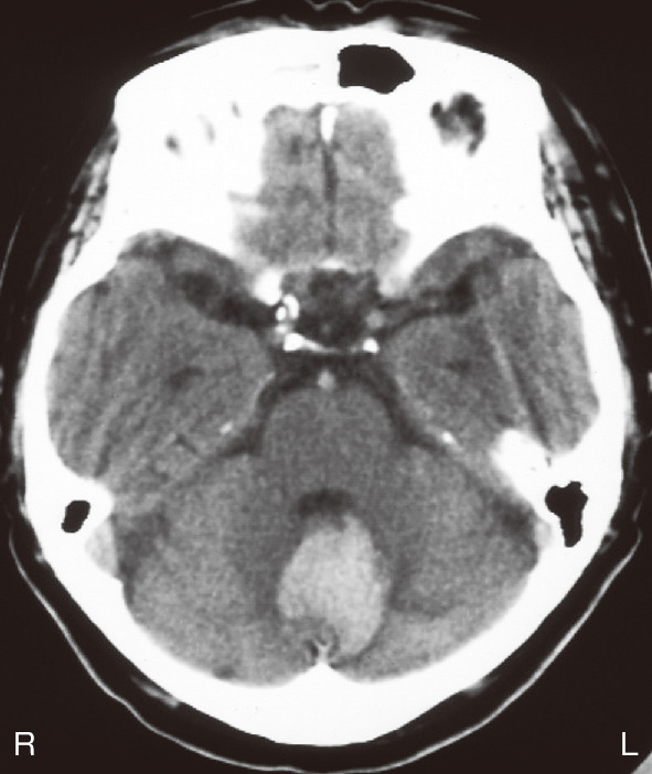 ⓔ図18-3-7　小脳出血によるめまい めまい，嘔吐，歩行障害で来院した63歳男性．小脳性の構音障害や左側優位の四肢の運動失調も明らかであった．CTで小脳出血を確認した．