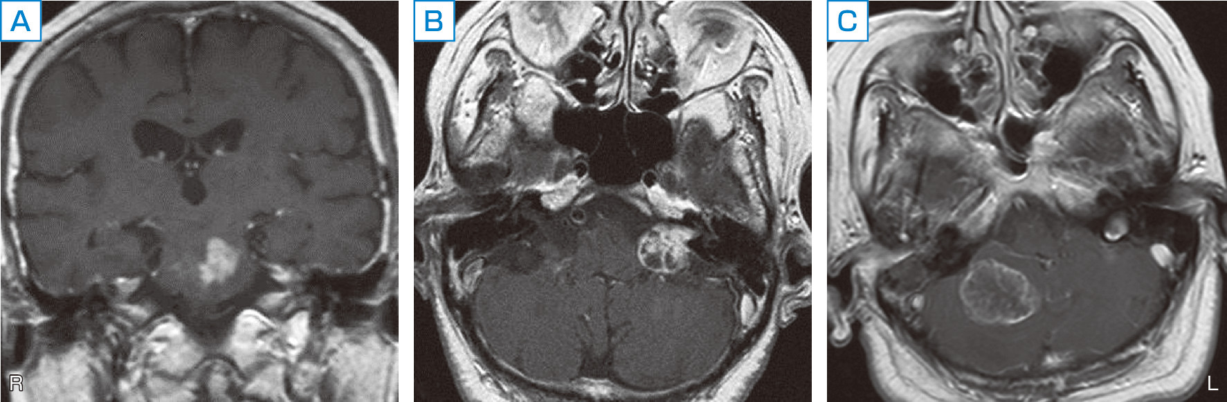 ⓔ図18-3-8　脳腫瘍によるめまい 脳幹や小脳に腫瘍ができればめまいを生じる．図は，71歳女性の橋に生じた神経膠腫 (A)，76歳女性の聴神経鞘腫 (B)，59歳女性の大腸癌の小脳転移 (C) のガドリニウム増強T1強調MRI画像を示している．