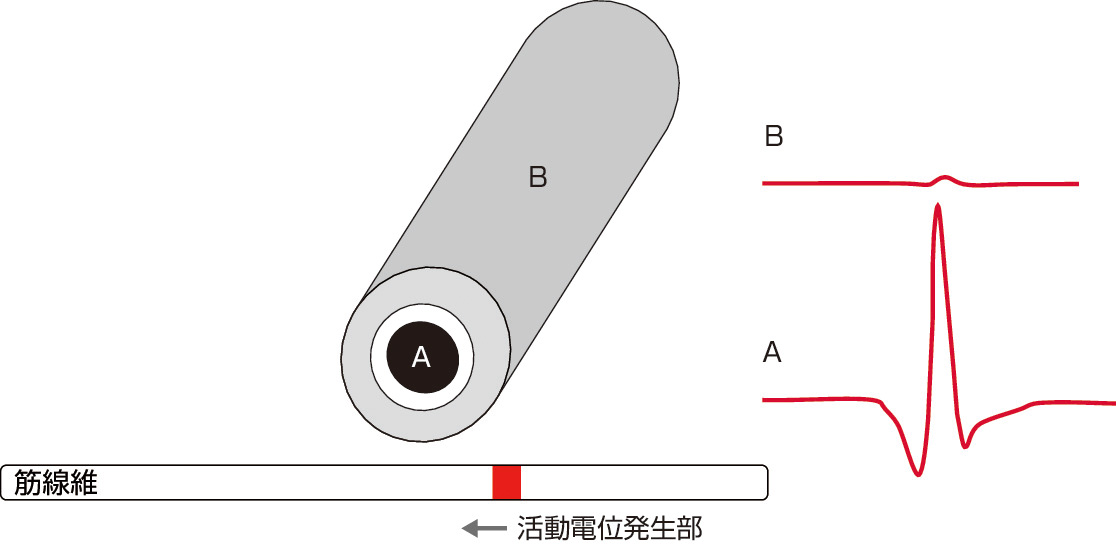 ⓔ図18-4-1　針電極の記録原理 同心型針電極では中心の導線の部分 (図黒A) が活性部となり筋線維の活動電位が記録される．この際，外筒 (ドットB) が基準電極となる．筋電図では電位差を記録するので，電位B–電位Aを記録することになる．筋線維の活動電位の発生部 (図赤) はAから見ると近接して遠ざかるが，BはAに比べ活動電位発生部からの距離の遠い部分が大半である．Bの外筒面は導体なので電位差は存在せず平均化されるため，Bでの平均記録電位はAに比べはるかに小さくなるため，実際の記録電位A–BはAの電位とほぼ同じとみなせる．なお筋線維の活動電位が近接して電極の下を通過し遠ざかっていく場合，Aで記録される電位は初期陽性，直下で陰性，後期陽性の三相波となる．