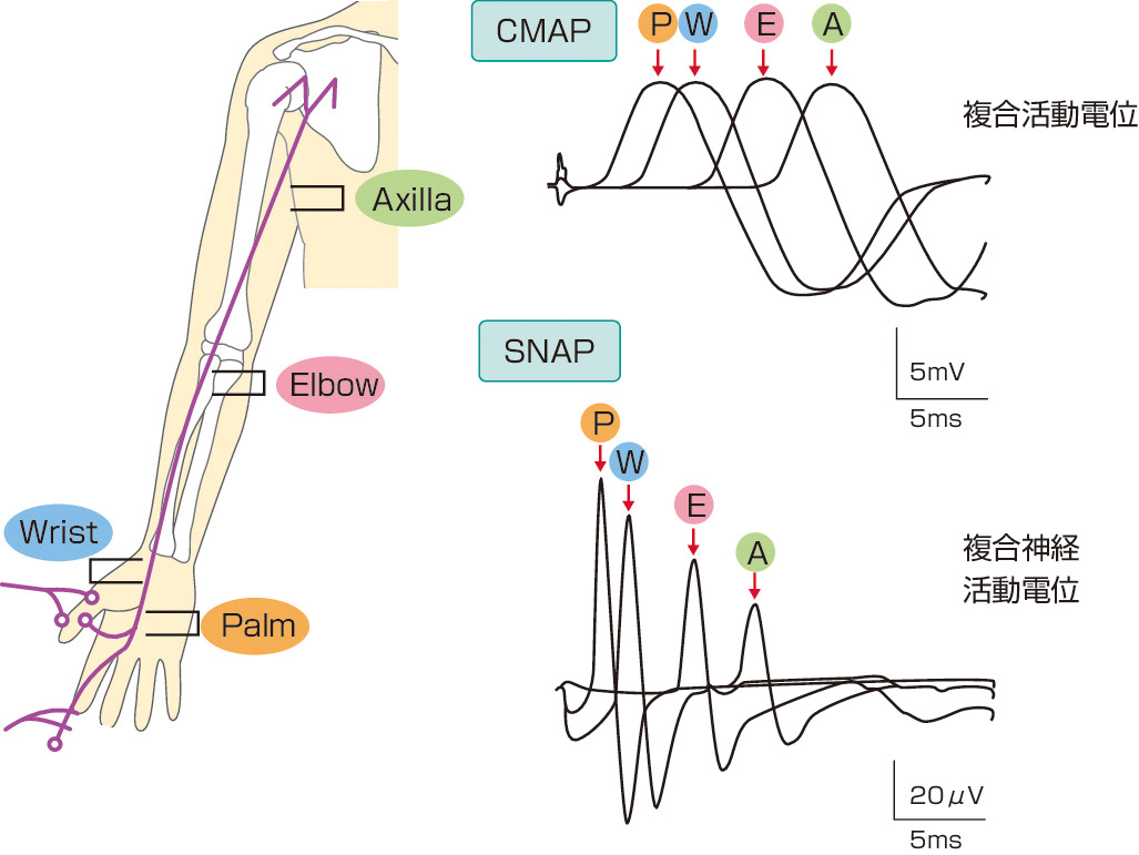 ⓔ図18-4-10　刺激部位による振幅の変化 (木村　淳，幸原伸夫：神経伝導検査と筋電図を学ぶ人のために，医学書院，2003) CMAPは刺激部位により振幅に大きな変化はないが，SNAPでは刺激部位と記録電極の距離が離れると次第に振幅が小さくなる．よく見ると持続時間も延長しているのがわかる．