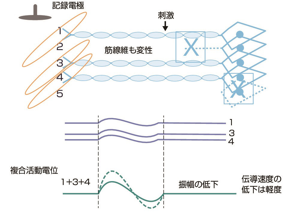 ⓔ図18-4-11　軸索変性の複合筋活動電位 (木村　淳，幸原伸夫：神経伝導検査と筋電図を学ぶ人のために，医学書院，2003) 軸索が変性すると，その運動単位が消失するため複合筋活動電位の振幅は低下する．残存する軸索の伝導性は保たれているために，伝送速度の低下は軽度にとどまる (ⓔ図18-4-6と比較)．