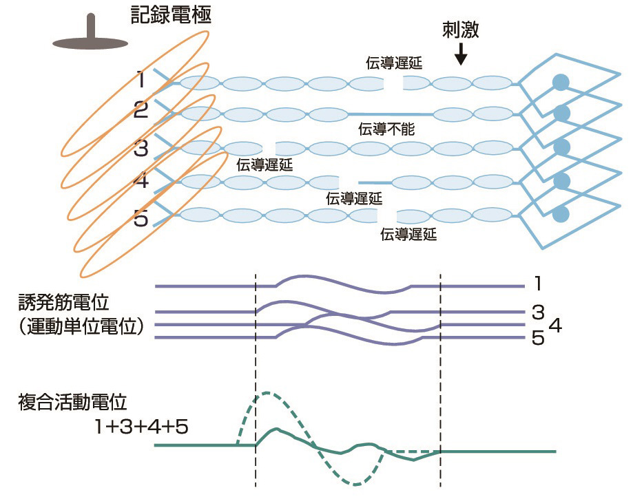 ⓔ図18-4-12　脱髄疾患での複合筋活動電位 (木村　淳，幸原伸夫：神経伝導検査と筋電図を学ぶ人のために，医学書院，2003) 髄鞘の障害により，軽度な場合は障害部での伝導遅延を生じ，高度の場合には伝導不能となる．また個々の神経の伝導時間のばらつきも大きくなる (時間的分散の増大)．この結果，これらの総和としての複合筋活動電位の潜時は遅延し，持続が長くなり波形は乱れる．障害が強いと振幅も低下する．また刺激閾値も上昇し，最大上刺激が困難な場合もある．