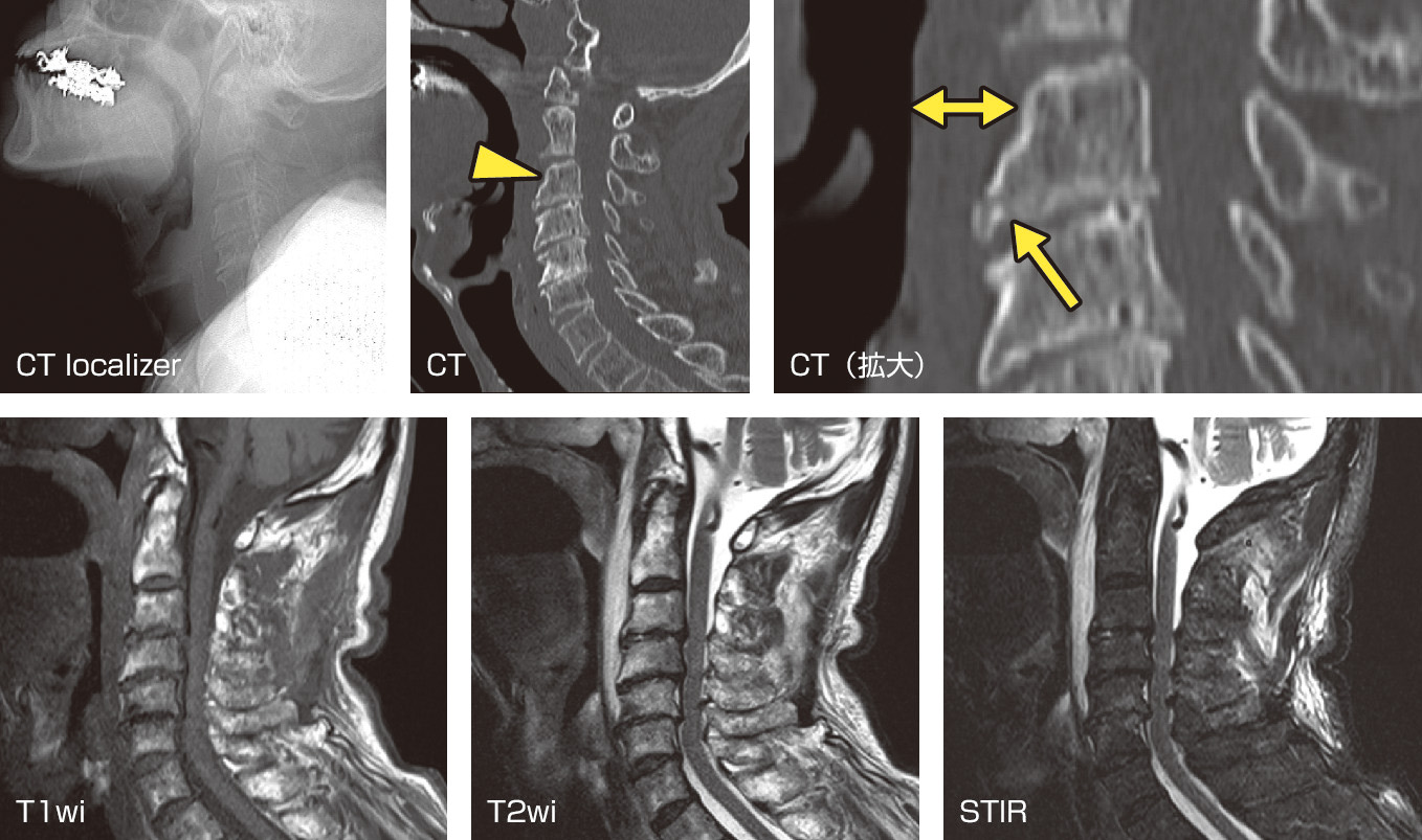 ⓔ図18-4-15　外傷におけるCTとMRI 80歳代，男性，自転車で転倒し前額部を強打．CTを撮影する際に撮られるローカライザーとよばれる画像は単純写真の代用になるので上段左端に提示した．この写真で椎体前方の軟部影が肥厚しているのがわかる．CTでも同様の所見が観察可能である (両矢印)．C3には涙滴骨折 (teardrop fracture) が観察可能である (矢印)．これは頸部の過伸展によって前縦靱帯が断裂したときに生じる特徴的な所見である．引き続き撮影されたMRIにて椎体前方に血腫が存在することがわかる．傍脊椎筋にはSTIRで信号異常がみられ過伸展時に生じた筋損傷と考えられる．棘突起や皮下組織の高信号も同様に外傷に伴う所見と考えられる．