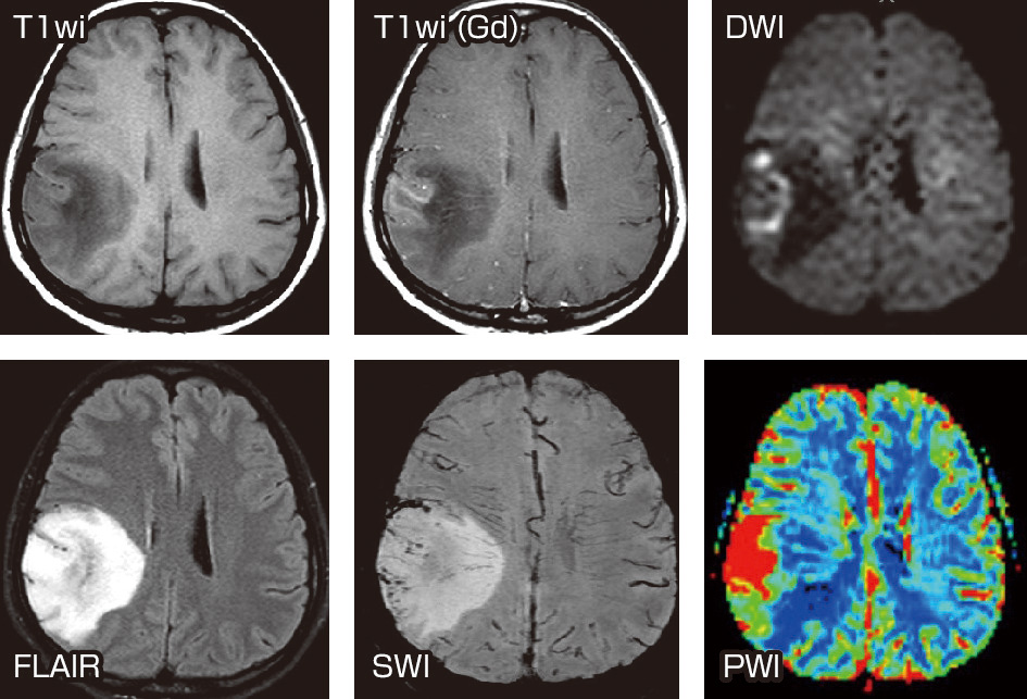 ⓔ図18-4-17　原発性脳腫瘍 (anaplastic astrocytoma; WHO grade Ⅲ) 20歳代，女性．右半球の腫瘤は造影前後のT1強調画像で腫瘤外側縁に沿ってわずかな濃染像を有する．拡散強調画像 (DWI) で同領域が高信号を呈するのは細胞密度の高さを反映していると考えられる．SWIでは同部における静脈がほかの部位よりも目立つ．灌流画像 (PWI) でも同部における血液量の上昇がみられる．上記のDWI, SWI, PWIの所見はいずれも病変の高悪性度を支持するものである．