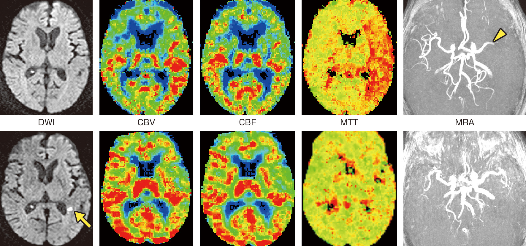 ⓔ図18-4-18　超急性期脳梗塞のMRI 70歳代，女性．発症2時間後 (上段),および8日後 (下段) のMRIを示す．初回検査ではMRAにて左中大脳動脈の途絶がみられる (矢頭)．拡散強調画像 (DWI) で急性期脳梗塞は指摘できない．一方,灌流画像では左中大脳動脈領域における平均通過時間 (mean transit time: MTT) の延長が観察される．このような所見上の解離をdiffusion–perfusion mismatchとよぶ．血栓融解療法を行った後に施行された追跡検査 (下段) ではMTTの左右差が解消している．拡散強調画像では脳室周囲の白質に1カ所，小さな高信号を認め急性期脳梗塞を反映している．灌流異常が存在した領域の大半が脳梗塞に至らずに済んだことになる． CBV: cerebral blood volume，CBF: cerebral blood flow.
