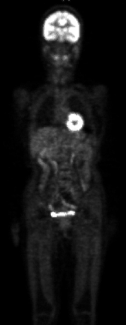 ⓔ図18-4-19　18FDG–PET像 正常の全身PET像を示す．脳と心臓で特に集積が強いのがわかる．咽頭における集積は正常である．またトレーサーは腎排泄されるため尿管や膀胱が描出されている．