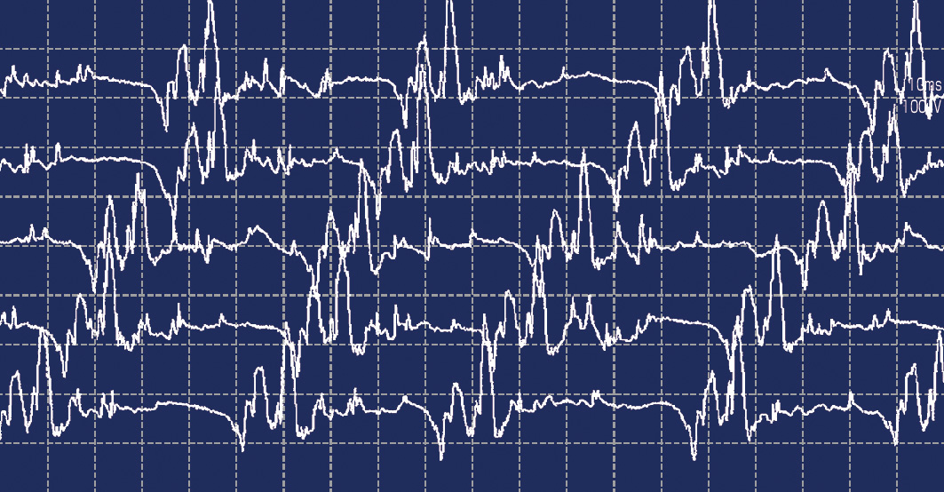 ⓔ図18-4-3　複合反復放電 (CRD) (10 ms/100 µV) 複雑な波形が約45 msec間隔で規則的に放電している．多数の筋線維がサーキットを形成し，繰り返して放電していると考えられる．