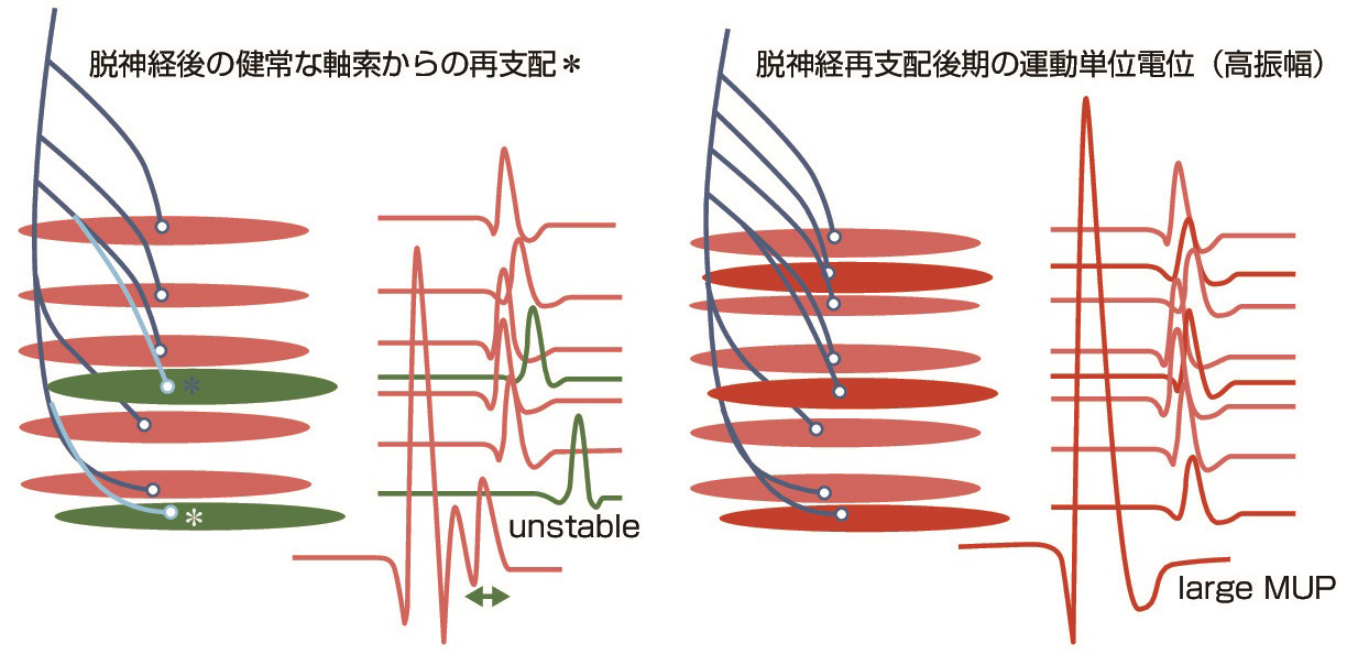 ⓔ図18-4-4　脱神経後の再支配と運動単位電位 脱神経で変性している筋線維に健常な軸索からの再支配が起こるが，最初は再支配を受けた軸索や髄鞘が未熟なため伝導が遅く不安定で波形が多相性で変動する (左図) が，時とともに安定した多相性電位となり，筋線維密度が高くなると高振幅電位となる (右図)．