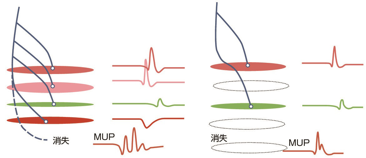 ⓔ図18-4-5　ミオパチーの運動単位電位 ミオパチーでは1つの運動単位に属する筋線維が変性し一部は消失，あるいは萎縮や肥大を生じるため，結果として筋線維数の減少と時間的ばらつきが大きくなる．この結果多相性の波形となる (左図)．肥大線維が電極に近接しているとスパイク様の持続の短い高振幅電位が記録されることもある．筋線維の変性が高度であると線維密度が低下し，1本か2本の筋線維の電位しか記録できないsmall motor unitとなる (右図)．