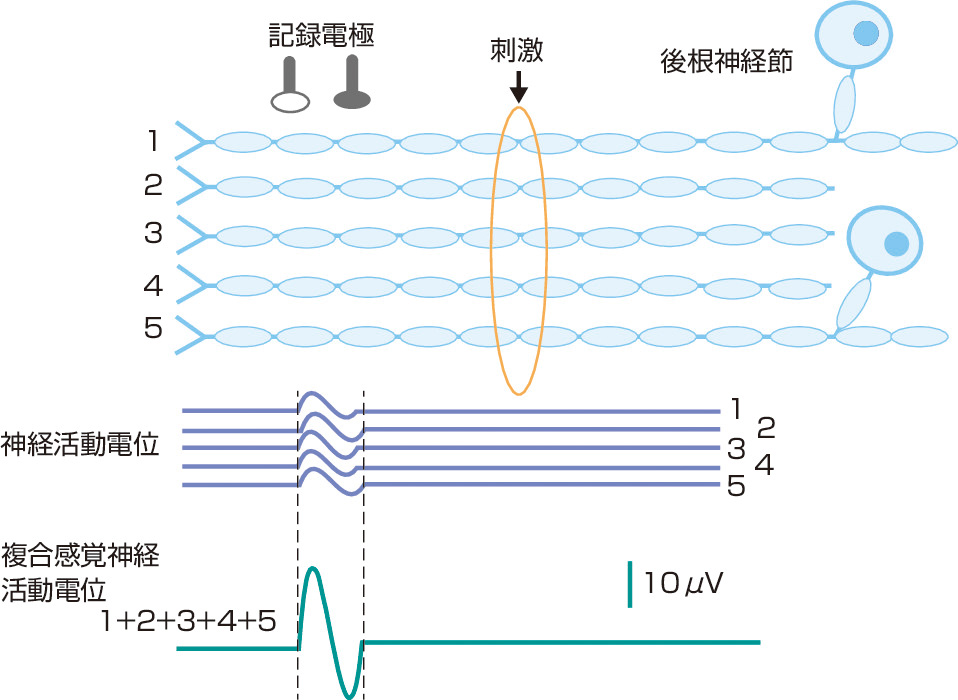 ⓔ図18-4-7　複合感覚神経活動電位 (SNAP) 感覚神経は，運動神経と異なり神経の活動電位が直接反映される．電気刺激により発生した，よく同期した各神経線維の活動電位の総和を複合感覚神経活動電位として記録しているのである．したがって運動神経での複合筋活動電位に比べ数百分の1程度の振幅となる．