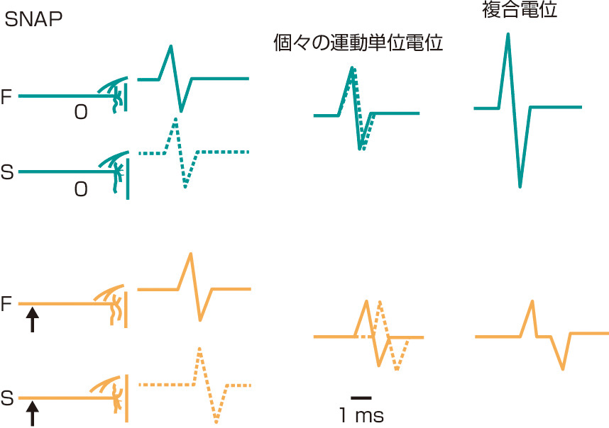 ⓔ図18-4-8　感覚神経電位における位相の相殺 (phase cancellation) (木村　淳，幸原伸夫：神経伝導検査と筋電図を学ぶ人のために，医学書院，2003) 感覚神経伝導検査では，個々の神経活動電位の総和を記録している．個々の活動電位の持続時間は短いため，近位刺激で伝導距離が長くなると，下図のように伝導時間のばらつきにより電位の位相のずれが起こり，位相の相殺を生じる．このため感覚神経では正常でも伝導距離が長いほどSNAP振幅は小さくなり，持続は長くなる．