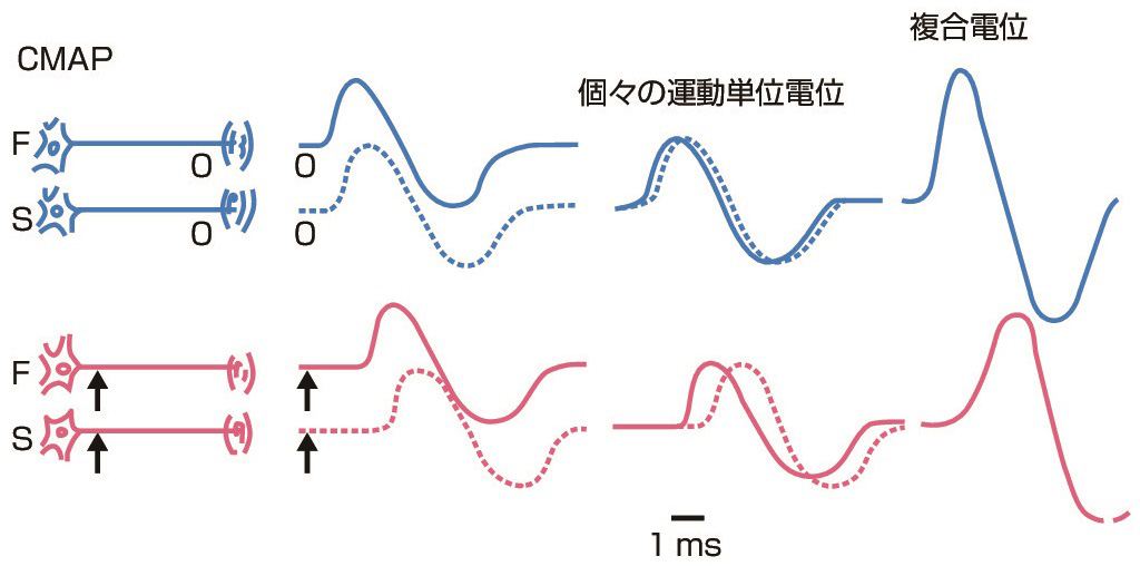 ⓔ図18-4-9　複合運動神経活動電位への距離の影響 (木村　淳，幸原伸夫：神経伝導検査と筋電図を学ぶ人のために，医学書院，2003) CMAPでは，SNAPに比べ，個々の運動単位電位の持続が長いので，神経伝導時間に多少の時間的なばらつきがあっても，神経活動電位のように位相が大きくずれることはなく，複合電位振幅への影響は少ない．