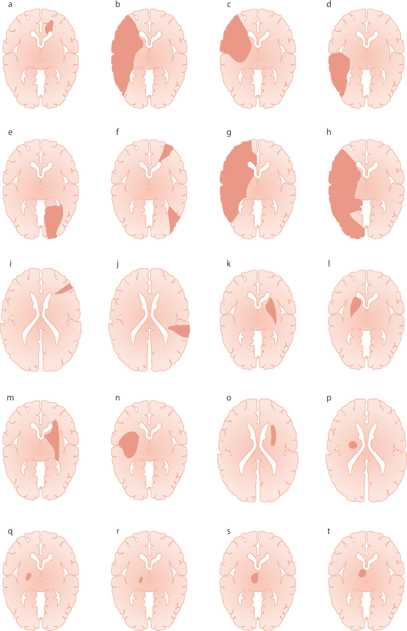 ⓔ図18-5-1　梗塞部位のシェーマ a：前大脳動脈領域梗塞 (血栓性のA2閉塞) b：中大脳動脈領域全体の梗塞 (塞栓性) c：中大脳動脈のsuperior trunk領域梗塞 (塞栓性) d：中大脳動脈のinferior trunk領域梗塞 (塞栓性) e：後大脳動脈領域梗塞 (塞栓性) f：分水嶺梗塞 (血栓性内頸動脈閉塞) g：2枝病変：前大脳動脈領域と中大脳動脈領域 (塞栓性) h：2枝病変：中大脳動脈領域と後大脳動脈領域 (塞栓性) i：軟膜動脈領域梗塞 (塞栓性) j：軟膜動脈領域梗塞 (塞栓性) k：線条体内包梗塞 (塞栓性あるいは血栓性中大脳動脈閉塞) l：線条体内包梗塞 (塞栓性あるいは血栓性中大脳動脈閉塞) m：extended large subcortical infarct (血栓性内頸動脈閉塞) n：extended large subcortical infarct (血栓性中大脳動脈閉塞) o：終末領域梗塞 (血栓性内頸動脈閉塞) p：ラクナ梗塞：pure motor hemiparesis (血栓性) q：ラクナ梗塞：pure motor hemiparesis (血栓性) r：視床梗塞：inferolateral infarct (血栓性) s：視床梗塞：paramedian thalamic infarct (塞栓性) t：視床梗塞：tuberothalamic infarct (血栓性)