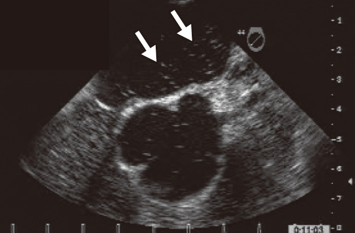 ⓔ図18-5-10　卵円孔開存の経食道心エコー像 (バブルテスト) 