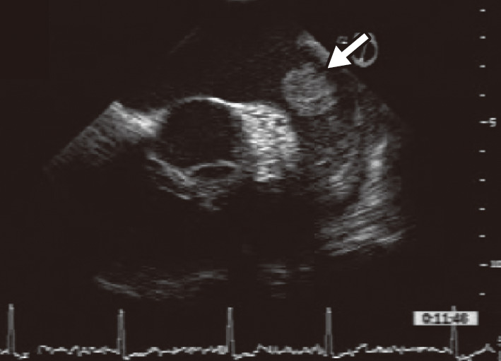 ⓔ図18-5-11　左房内血栓の超音波像 