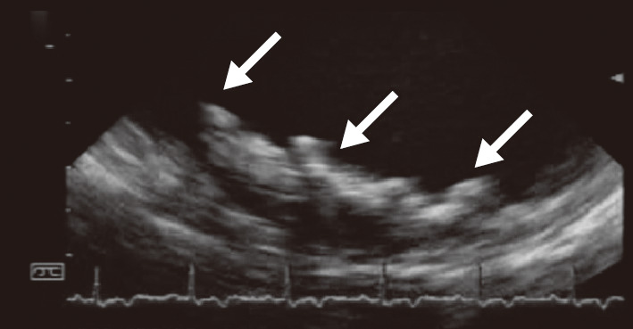 ⓔ図18-5-12　大動脈弓の粥状硬化性病変の超音波像 