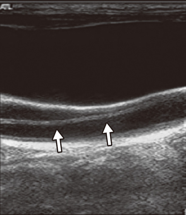 ⓔ図18-5-13　胸部大動脈解離の総頸動脈への波及 (頸部血管エコー像) 