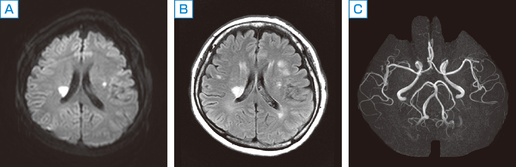 ⓔ図18-5-16　本態性血小板血症による脳梗塞の画像所見 WBC：8200 103/µL，RBC：553 104/µL，Hb：15.2 g/dL，Ht：45.8%，Plt：67.8万104/µL，JAK2遺伝子変異陽性．