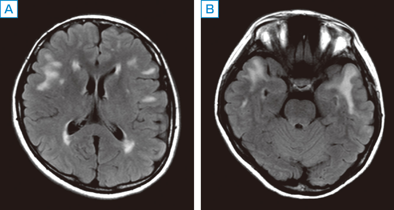 ⓔ図18-5-17　CADASILによる脳梗塞のMR像 側頭葉極と大脳白質に病変がみられる．